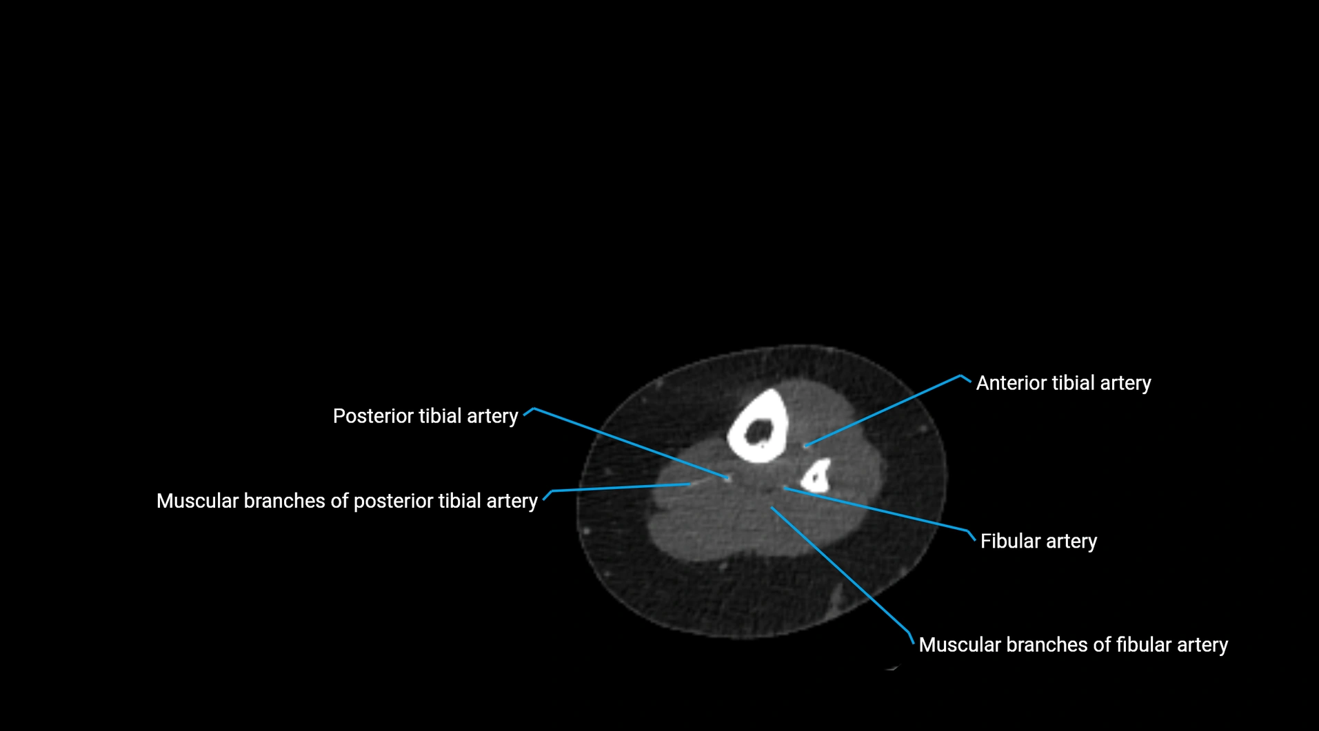 CTA lower limb cross sectional anatomy labelled image _224.webp